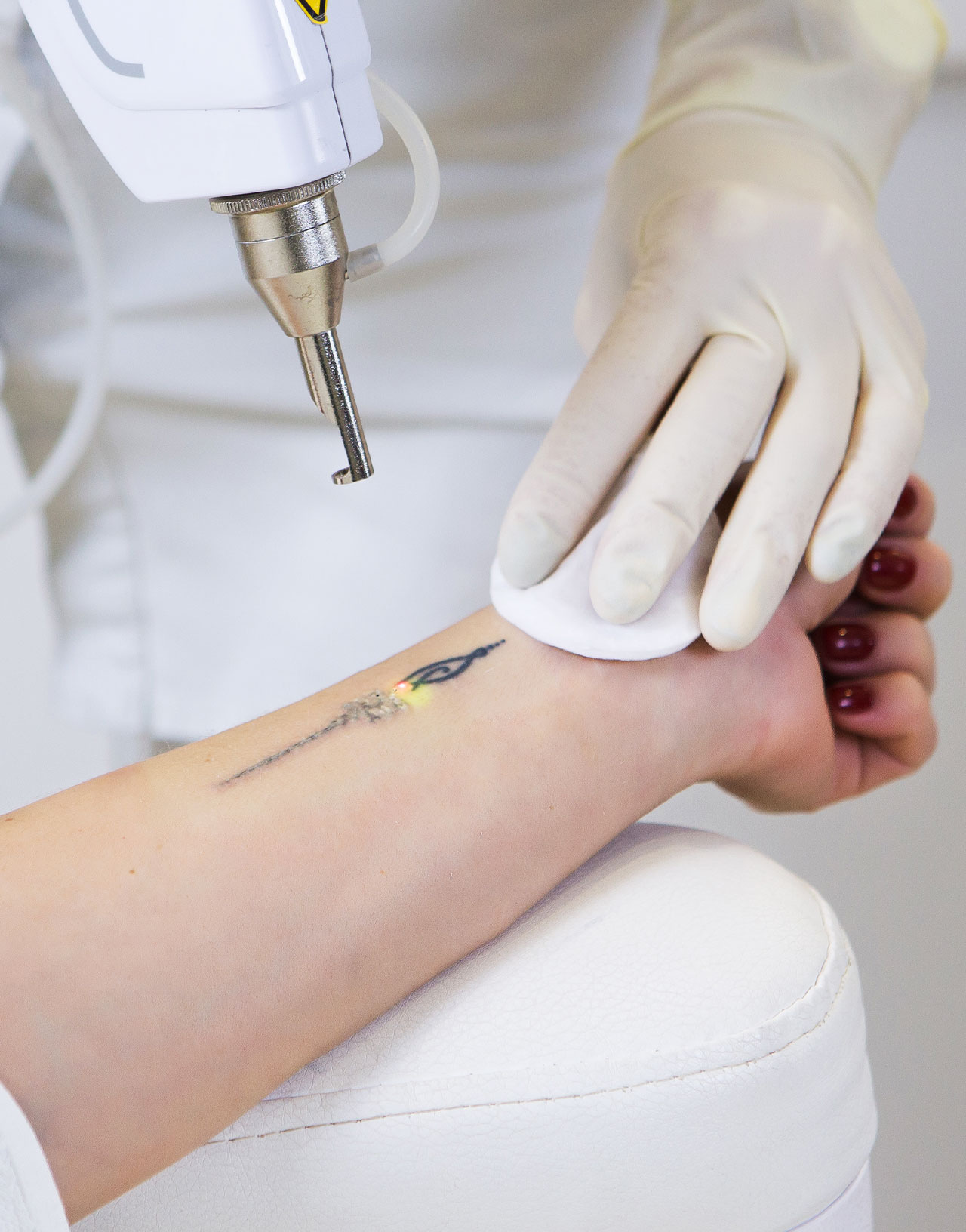 Best Laser Tattoo Removal Southend Essex | £49 Per Session