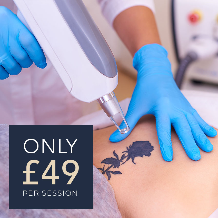 Best Laser Tattoo Removal Southend Essex | £49 Per Session